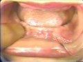 Lec 19 - Gingival Hyperplasia Edentulous Alveolar Ridges