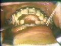 Lec 34 - Mounting the Maxillary Cast on the Articulator