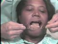 Lec 29 - Removal of Large Ameloblastoma of Mandible