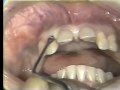Lec 30 - Surgery for Immediate Complete Denture