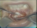 Lec 31 - Removal of an impacted mandibular canine