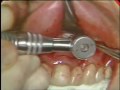 Lec 32 - Periapical Surgery - Scallop Flap