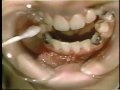 Lec 40 - Central Giant Cell Granuloma of the Mandible