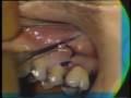 Lec 53 - Removal of Root Fragments From Maxillary Sinus