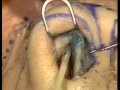 Lec Last - Rhinoplasty Course Dissection