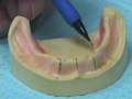 Lec 10 - X-Ray Guide: Overdentures