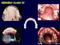Lec 17 - DENT 718: Classification and components of removable partial dentures