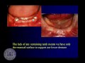 Lec 19 - DENT 718: Tooth supported overdentures