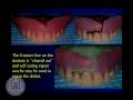Lec 30 - Mechanical Articulation and Posterior Tooth DesignLec 30 - Mechanical Articulation and Posterior Tooth Design