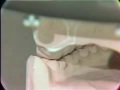 Lec 6- Occlusal Adjustment of Mounted Cast