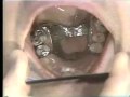 Lec 57 - Occlusal-Partial Denture Failure