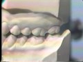 Lec 79 - Occlusal Examination of Correctly Articulated Casts