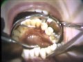 Lec 10 - Subgingival Curettage