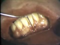 Lec 12 - Sliding Flap with Free Gingival Graft