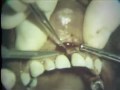 Lec 13 - Gingival and Bone Grafting for New Attachment