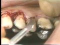 Lec 18  - Periodontal Surgery (Muco-Periosteal Flap)