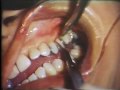 Lec 28 - Surgical Elimination of Periodontal Pockets