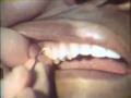 Lec 30 - Scaling and Root Planing: Maxillary Teeth