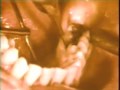 Lec 40  - Elimination of Shallow Infrabony Pocket by Ostectomy in Retromolar Area
