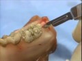 Lec 44  - Introductory Periodontal Surgery Techniques: Distal Wedge