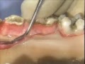 Lec 46  - Introductory Periodontal Surgical Techniques: The Apically Positioned Flap and Crown Lengthening