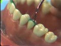 Lec 14- Dental Anatomy: Waxing a Maxillary Second Bicuspid