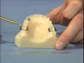 Lec 46 - Distalizing Maxillary Molars