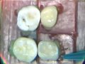 Lec 20- Dental Anatomy: Primary Dentition Review