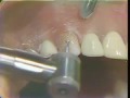 Lec 89  - Maxillary Cuspid Preparation for a Porcelain Fused to Gold Crown