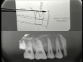 Lec 19 - Periapical Radiography - Long Cone