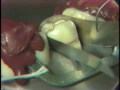 Lec 5 - Packing and Carving of Class I and V Amalgam for Hygienists