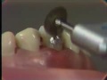 Lec 6 - Class V Amalgam Restoration: Finishing and Polishing