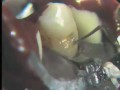 Lec 22 - Class V amalgam: Cavity liner and cement base