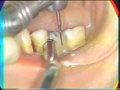 Lec 1 - Endodontic Surgery: Hemisection