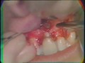 Lec 22 - Periapical Surgery: Muco-Periosteal Flap