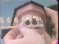 Lec 131  - Anterior Temporary Crowns