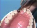 Lec 160 -Vinyl Polysiloxane Impression for Anterior Bridge