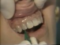 Lec 161 -Anterior  Porcelain Laminates for DiscoloredTeeth