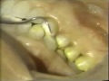 Lec 162 -Posterior Porcelain Laminates for DiscoloredTeeth