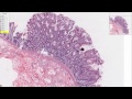Lec 10 - Hyperplasia in Colon Tissue