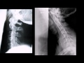 Lec 13 - Adequacy of the Lateral Cervical Spine X-Ray