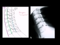 Lec 14 - Assessing Alignment of the Lateral Cervical Spine (neck) X-Ray
