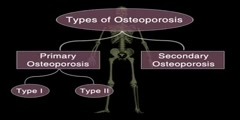 Osteoporosis causes weakness to bone
