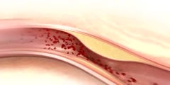 Coronary Disease Animation