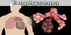 Chronic obstructive pulmonary