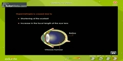 Common Vision Defects