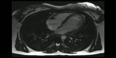 MRI of Beating Heart