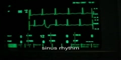 What is Ventricular Bigeminus?