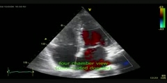 A Detailed Study of Echocardiography