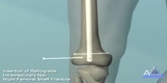 Repair of  Fracture - Thigh and Hip